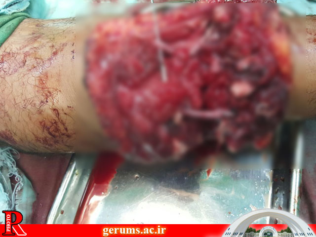 پیوند شگفت‌انگیز دست بریده در بیمارستان گراش