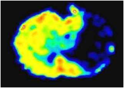 محقق گراشی یک شاخص پزشکی جدید در بیماری‌های قلبی عروقی پیشنهاد داد