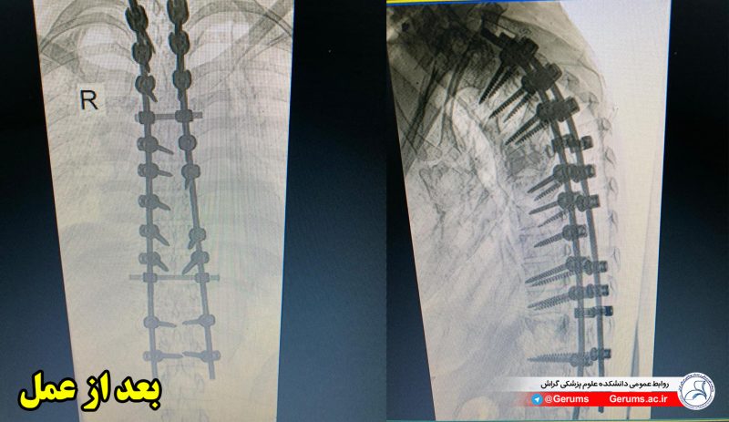 جوان کمرشکسته، چهار ساعت در اتاق عمل